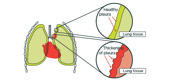 [image] Diagram showing comparison of healthy and thickened pleura