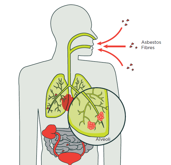 [image] Diagram showing asbestos lodged in lungs