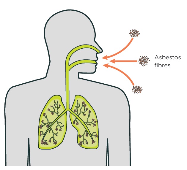Cross-section diagram showing asbestos fibres breathed into lungs